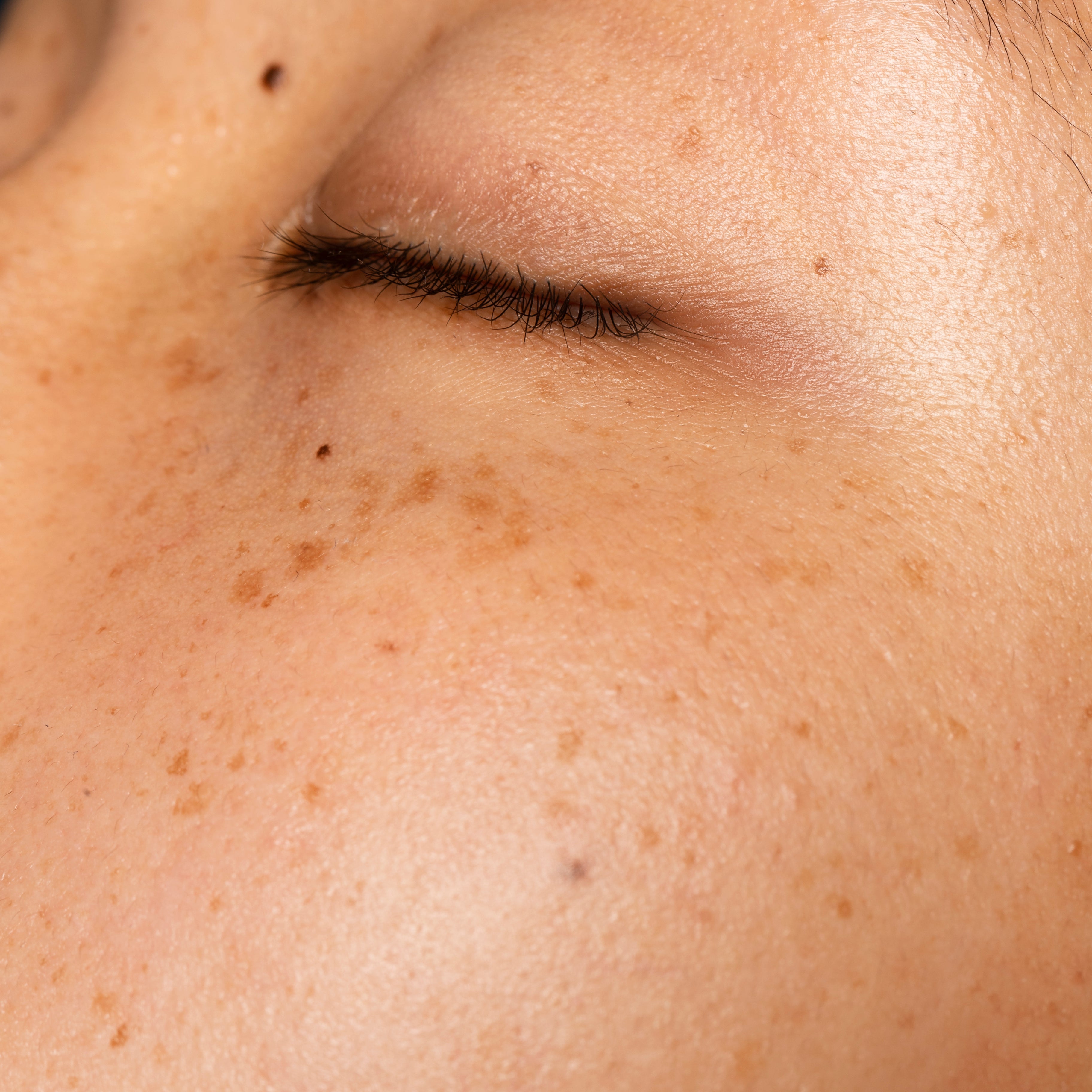 Can Vitamin C Really Fade Dark Spots?